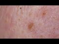 0327 keratin plug removal nose