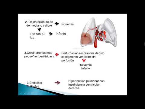 TROMBOEMBOLISMO PULMONAR