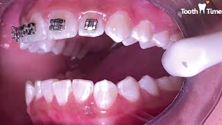 How they put braces on - 13 years old patient - Tooth Time Family Dentistry New Braunfels Texas