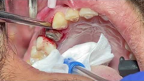 Tooth extraction using straight elevator