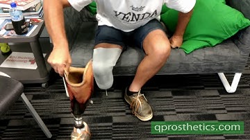 Donning of the prosthesis with liner and pin lock