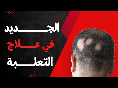 مرض التعلبة الاعراض الاسباب خطوات العلاج احدث الادوية المتاحة للعلاج
