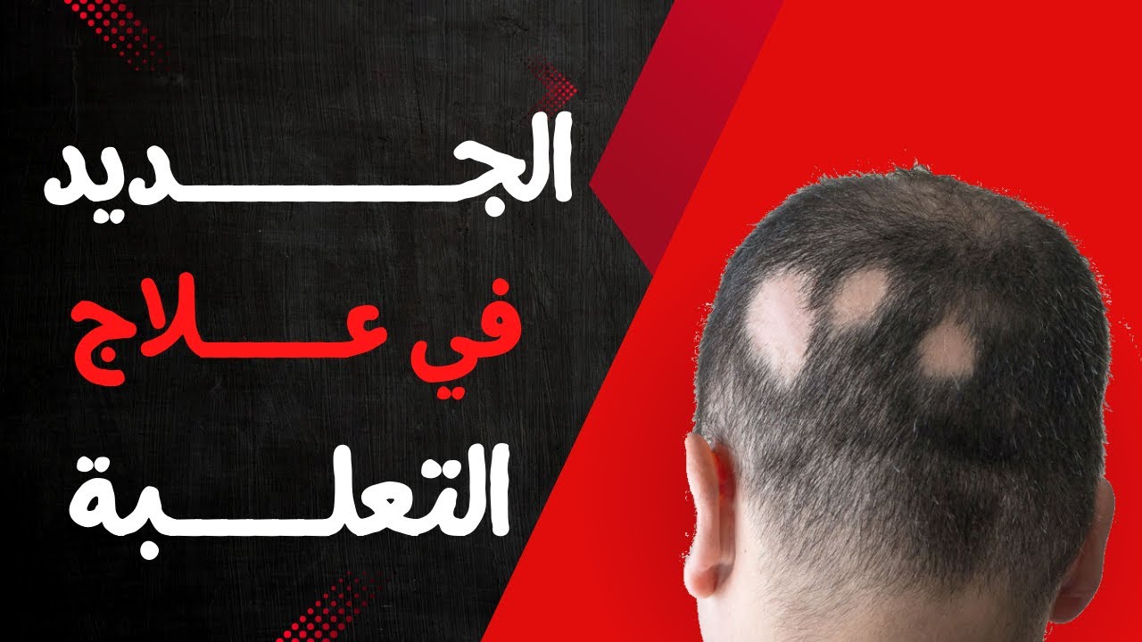 مرض التعلبة | الاعراض | الاسباب  | خطوات العلاج | احدث الادوية المتاحة للعلاج