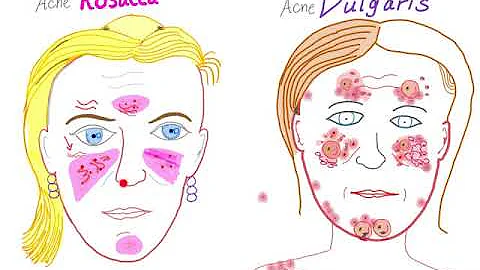 Come guarire dall acne rosacea?