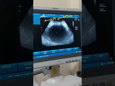 ورم ليفي بالرحم