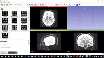 sfMRI/DTT using 3D-Slicer (sample footage)