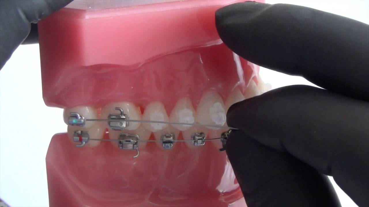 Déroulement de traitement (l'arc)