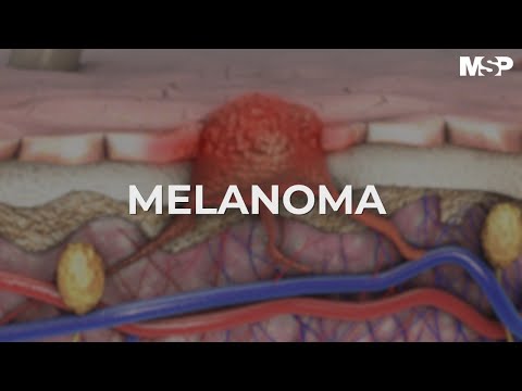 Vídeo: Melanoma Cerebral: Melanoma En La Cabeza