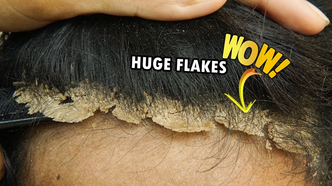 Huge Dandruff Flakes In Hair Removing And Picking 445 YouTube
