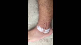 Escociano nhs tobillo roto