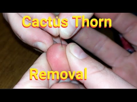 Removing 7 week old Cactus thorn