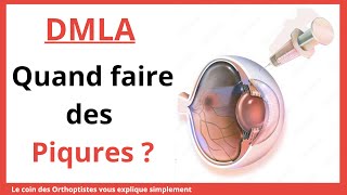 Comment soigner la DMLA ? Quels sont les symptômes de la DMLA ? (Maladie des yeux)