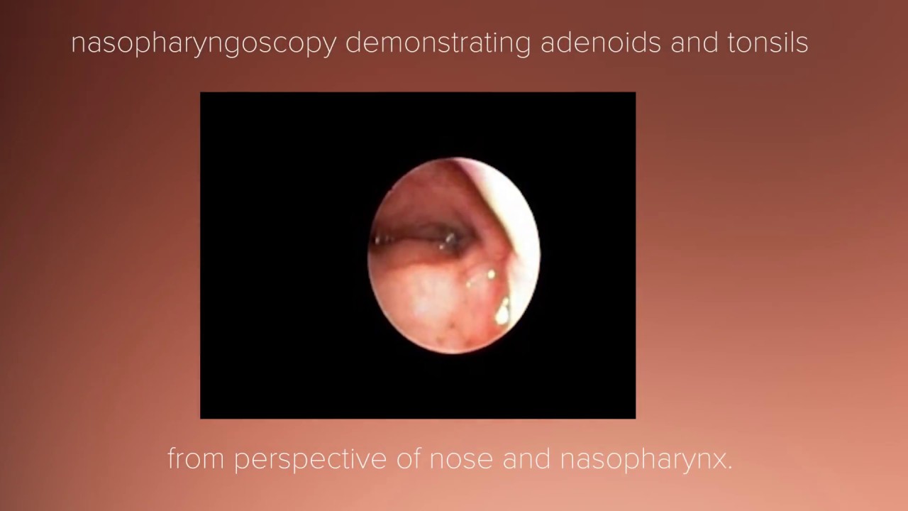 Tonsil and Adenoid Anatomy Review - YouTube