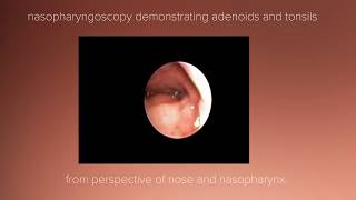 Tonsil and Adenoid Anatomy Review