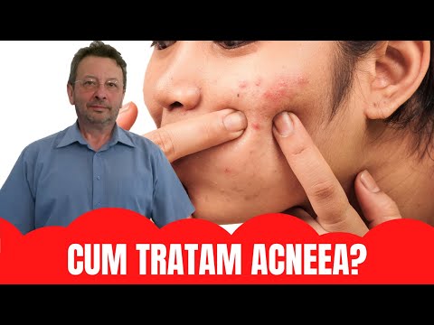Video: Cum se tratează acneea cu curcuma: 11 pași (cu imagini)