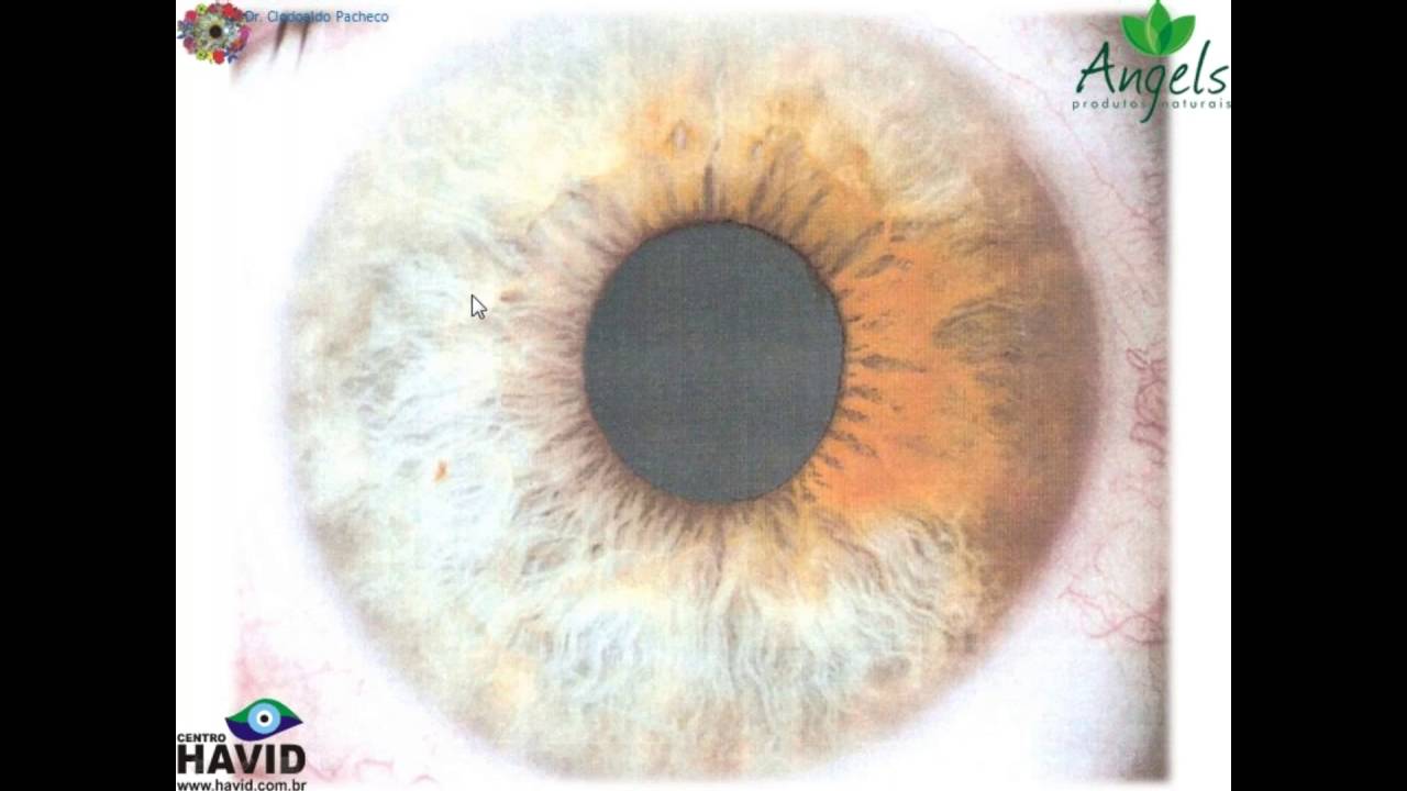 Ansiedade & Depressão - Iridologia Contemporânea (Microsemiótica Iridea)