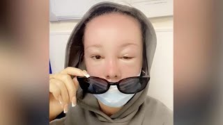 Frau erleidet Sonnenvergiftung und bekommt ihre Augen kaum noch auf by stern 1,086 views 10 months ago 1 minute, 31 seconds