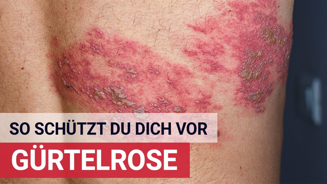 Darf Ich Mit Gürtelrose In Der Pflege Arbeiten So schützt du dich vor Gürtelrose! - YouTube