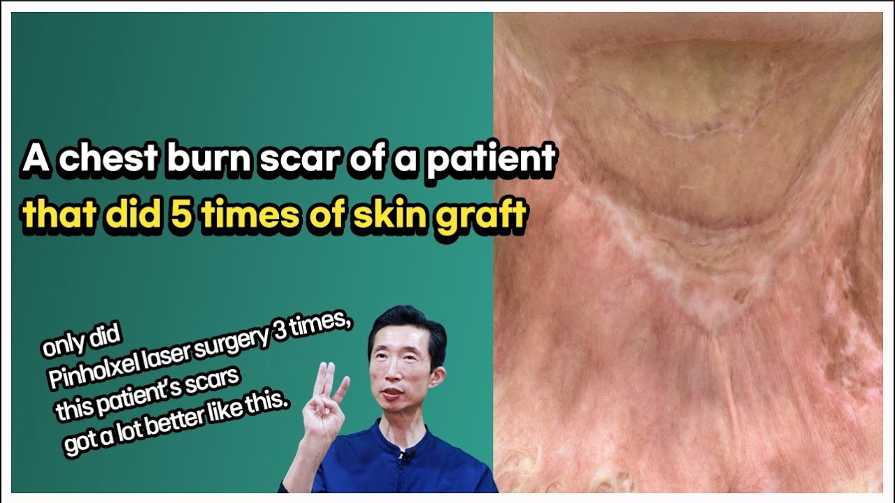 A chest burn scar of a patient that did 5 times of skin graft. YouTube