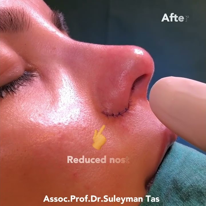 Nostril Reduction Surgery Before After