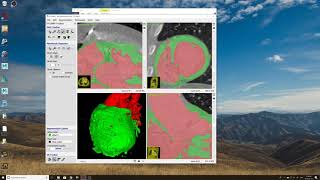 Using ITK-Snap to Model the Myocardium of a Heart
