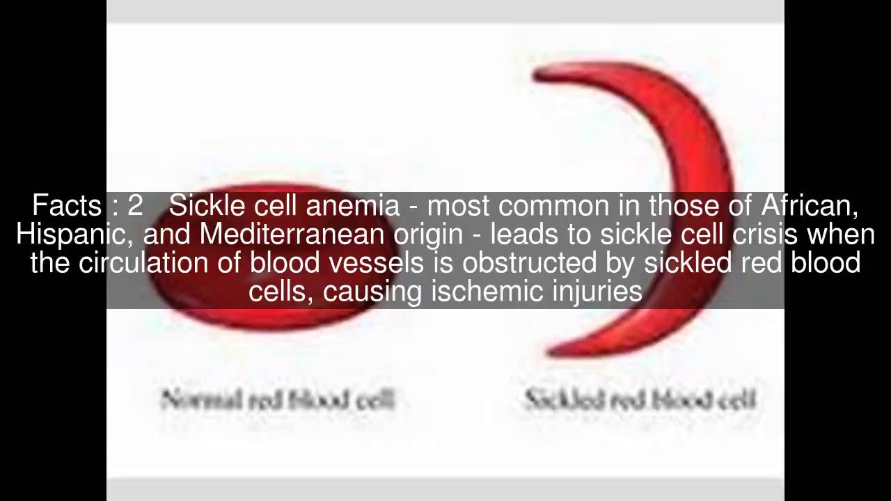 Vasoocclusive crisis Top 5 Facts YouTube