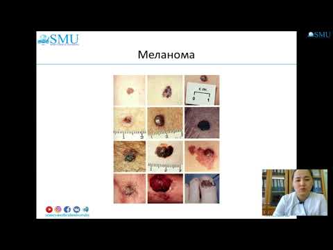 Бейне: Сквирм жасушалы ісік дегеніміз не?