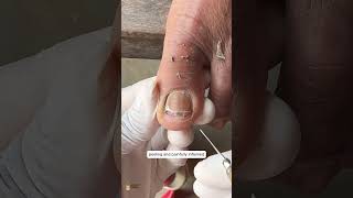 Severe Ingrown Toenail Treatment | How to Fix an Ingrown Toenail Safely