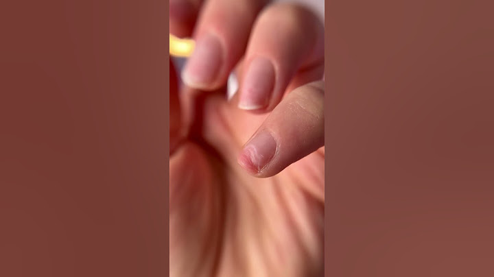 Onycholiza na paznokciu #manicure #nails #paznokcie