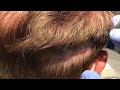 No-Shave FUE Correction of FUT Scar in HD