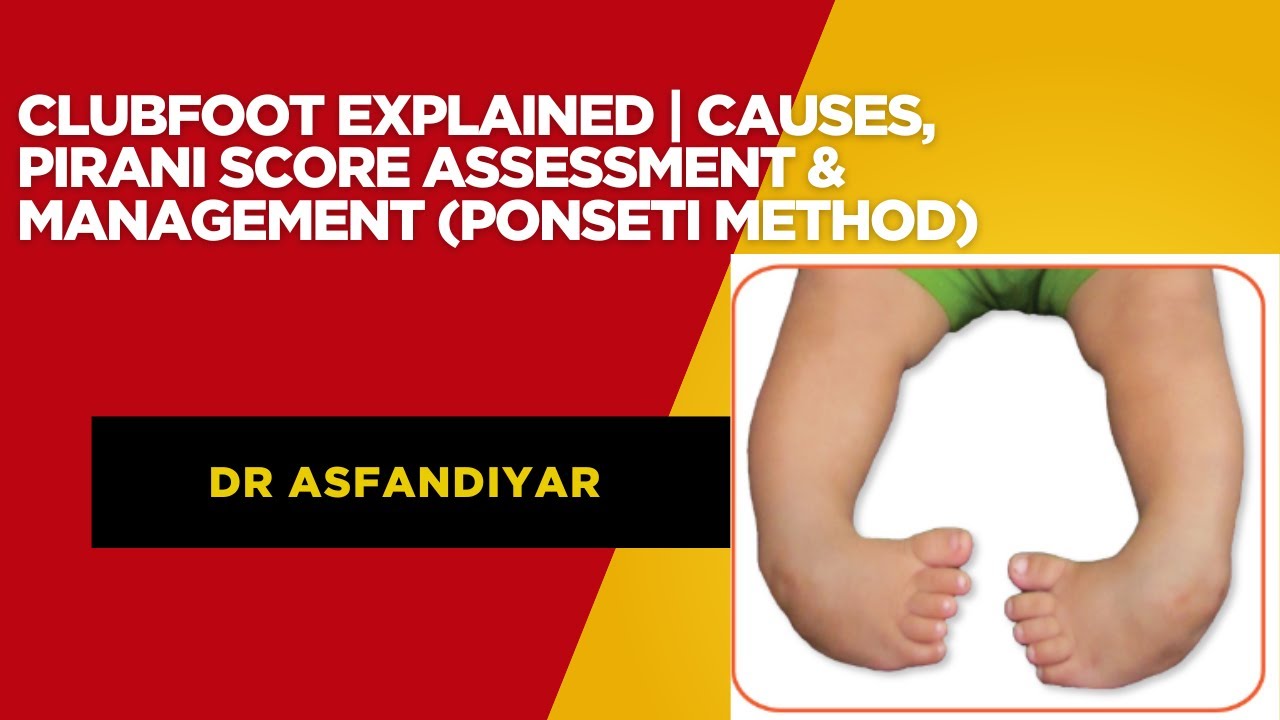 Clubfoot Explained | Causes, Pirani Score Assessment & Management (Ponseti Method) Dr Asfandiyar