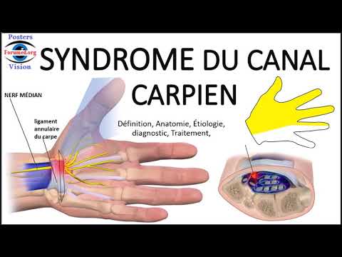 Vidéo: Les renforts de préhension aident-ils le canal carpien ?