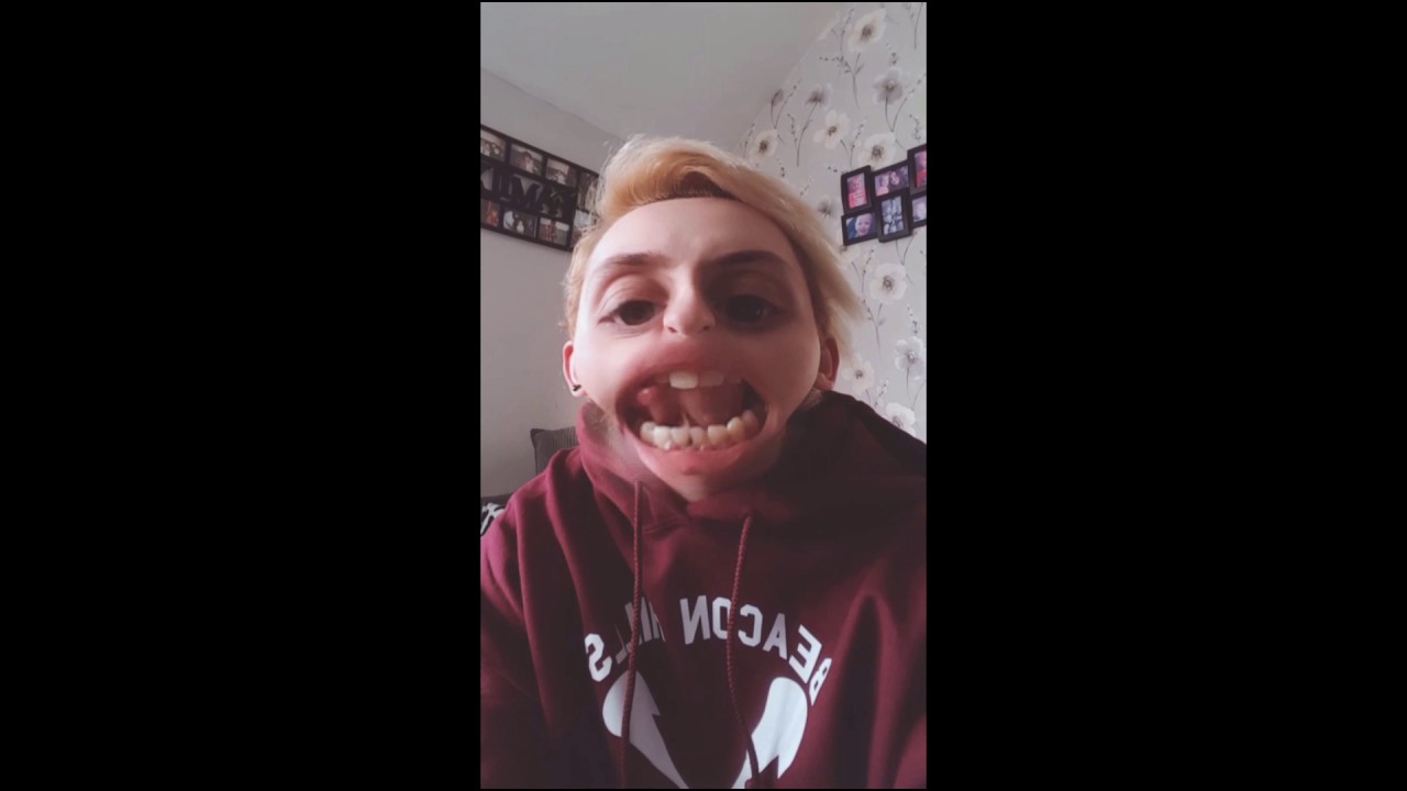 Lip Filler gone bad part 1 & 2 YouTube