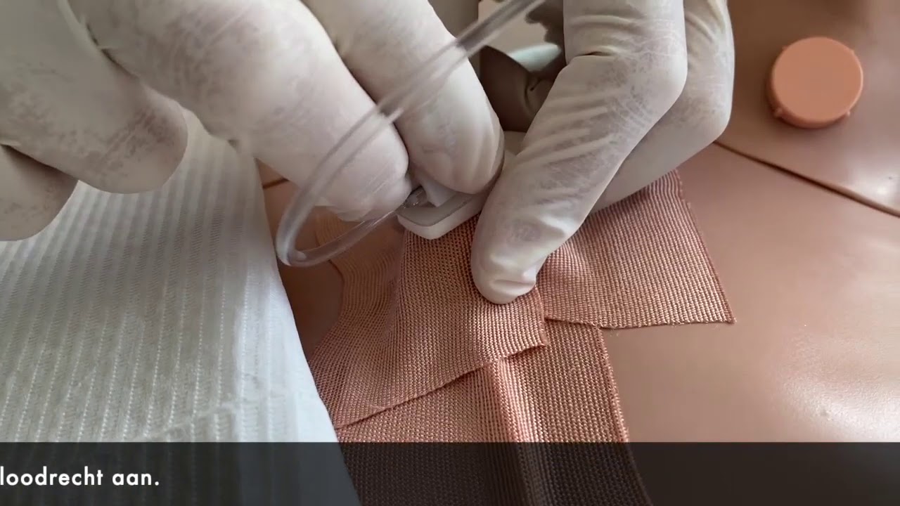 Bloedafname via de poortkatheter