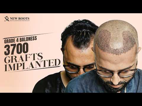 Hair Transplant in Lucknow: Grade 4 and Crown Baldness Treatment 🙂 | New Roots