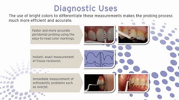 The Hu-Friedy Colorvue® Goldstein Probe