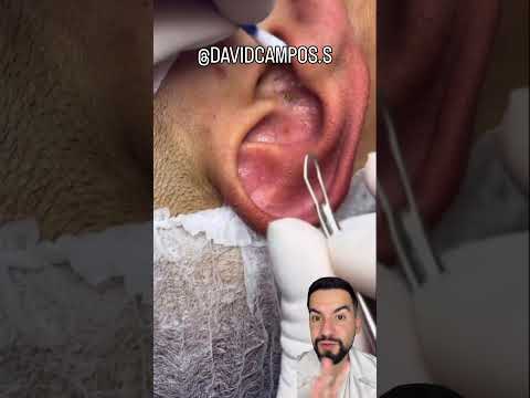 QUISTE SEBÁCEO