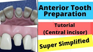 Anterior Crown Preparation - Demonstration (Super Easy)