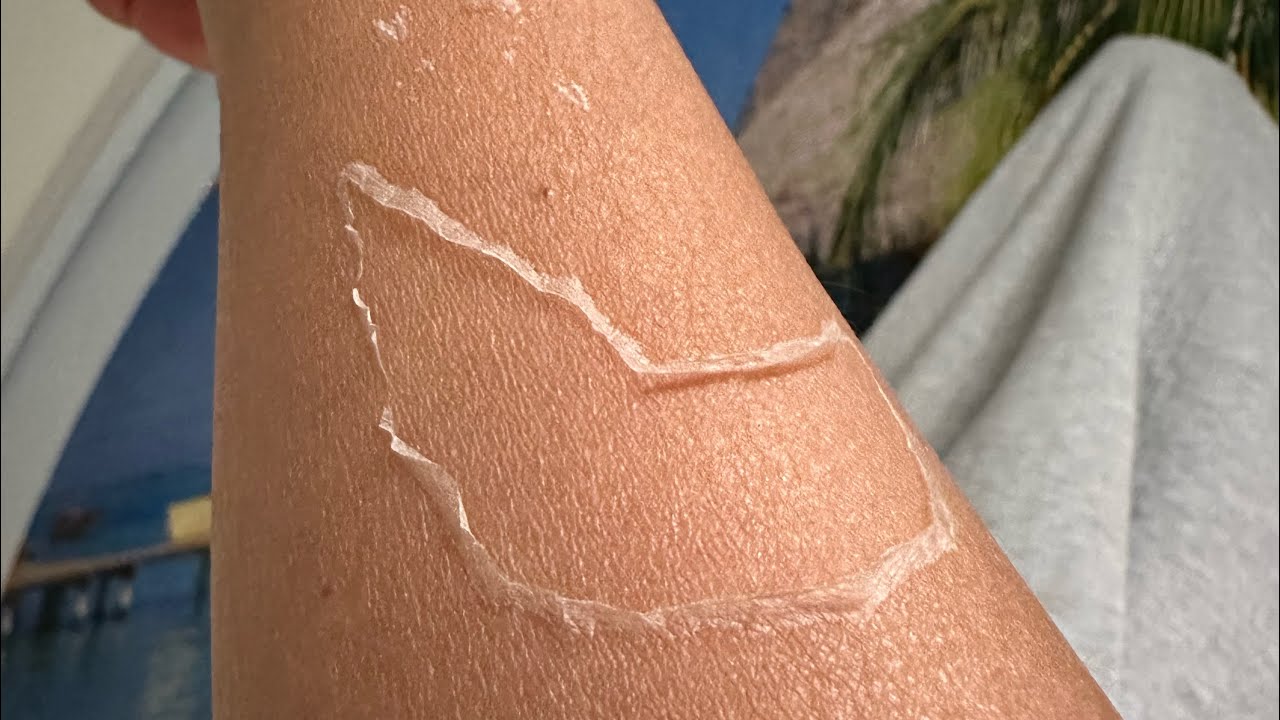 曬傷脫皮補救⋯