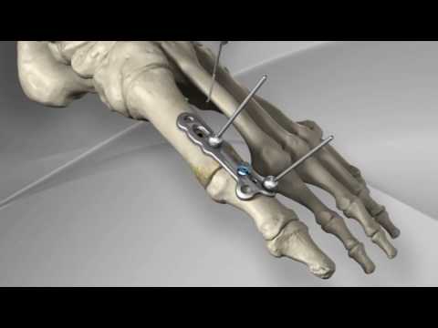 First Metatarsophalangeal Joint Fusion with Arthrex® MTP Fusion Plate