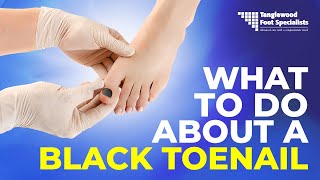 What to do About a Black Toenail