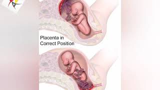 Casharkii 1 aad ee Placenta Previa wax kale maahan waa Ibida kubaro sifudud Cafimaadka Haweenka.