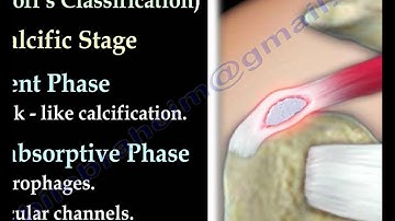 Calcific Tendonitis - Everything You Need To Know - Dr. Nabil Ebraheim