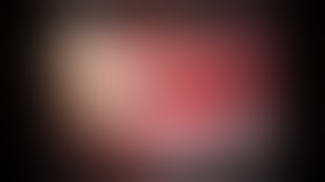 clipping of left Pcom aneurysm with fetal PCA  by pterional craniotomy