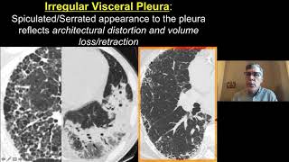 Consolidation and Ground Glass - Imaging Approach to Fibrosis