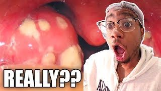 (BUT WHY??) HORRIBLE TONSILS STONE REMOVAL!!!