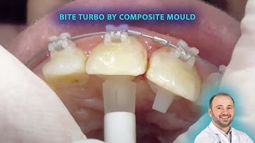 Composite mould for placing on bite turbo or bite separation for deep bite, bonding bite plane