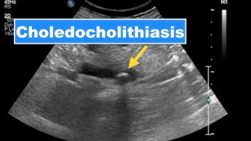 Choledocholithiasis I Ultrasound