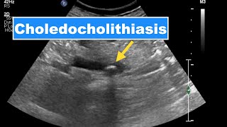 Choledocholithiasis I Ultrasound