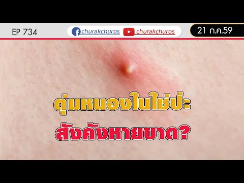 มีตุ่มหนองที่น้องสาว คือหนองในหรืือเปล่า? / สังคัง ต้องรักษายังไง - ชูรักชูรส ep 734